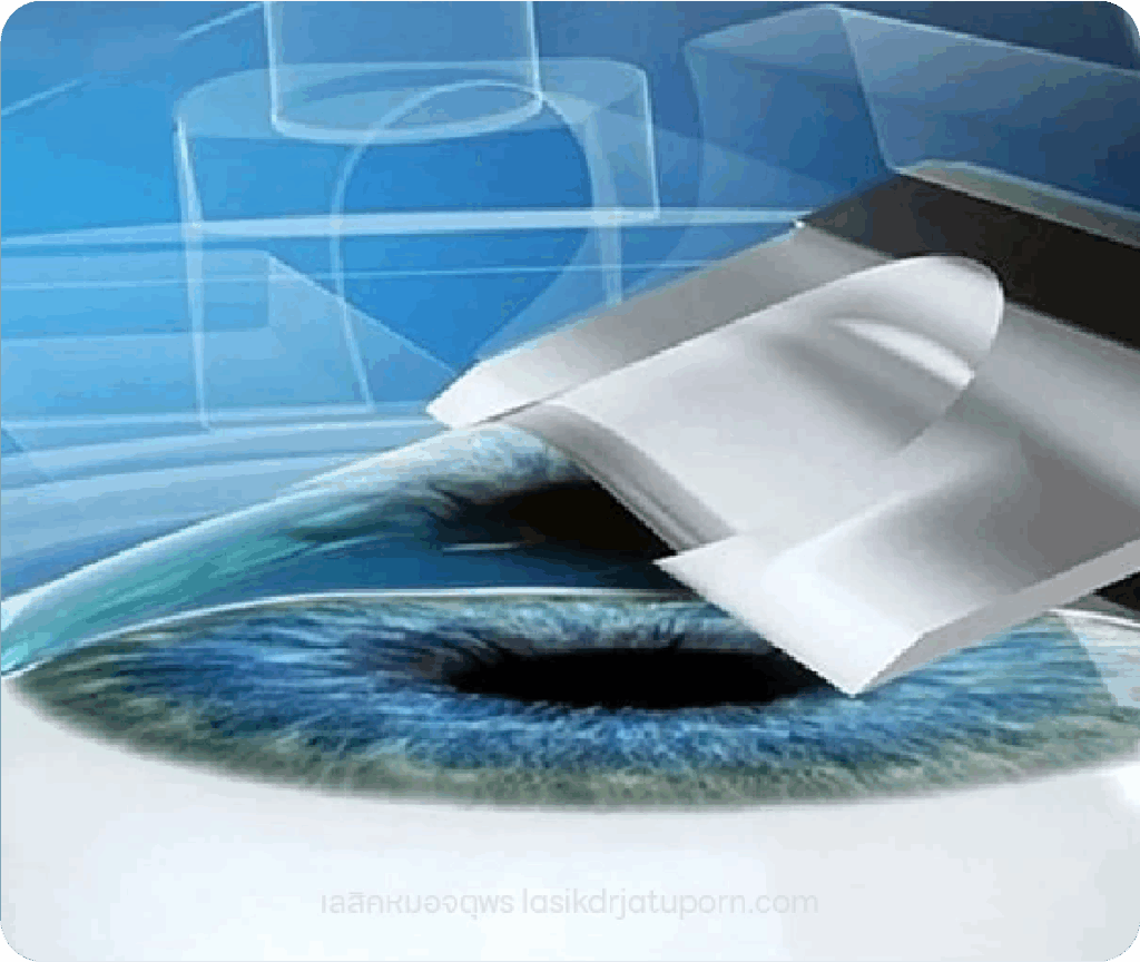 SBK LASIK
