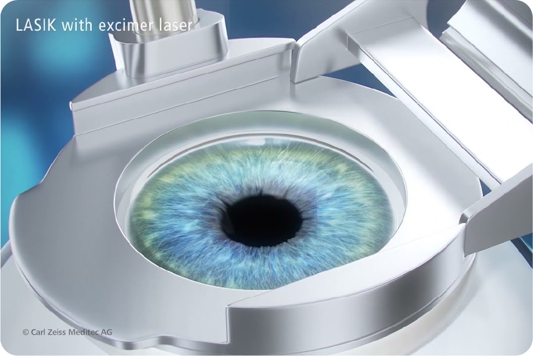 เทคโนโลยี SBK LASIK คืออะไร