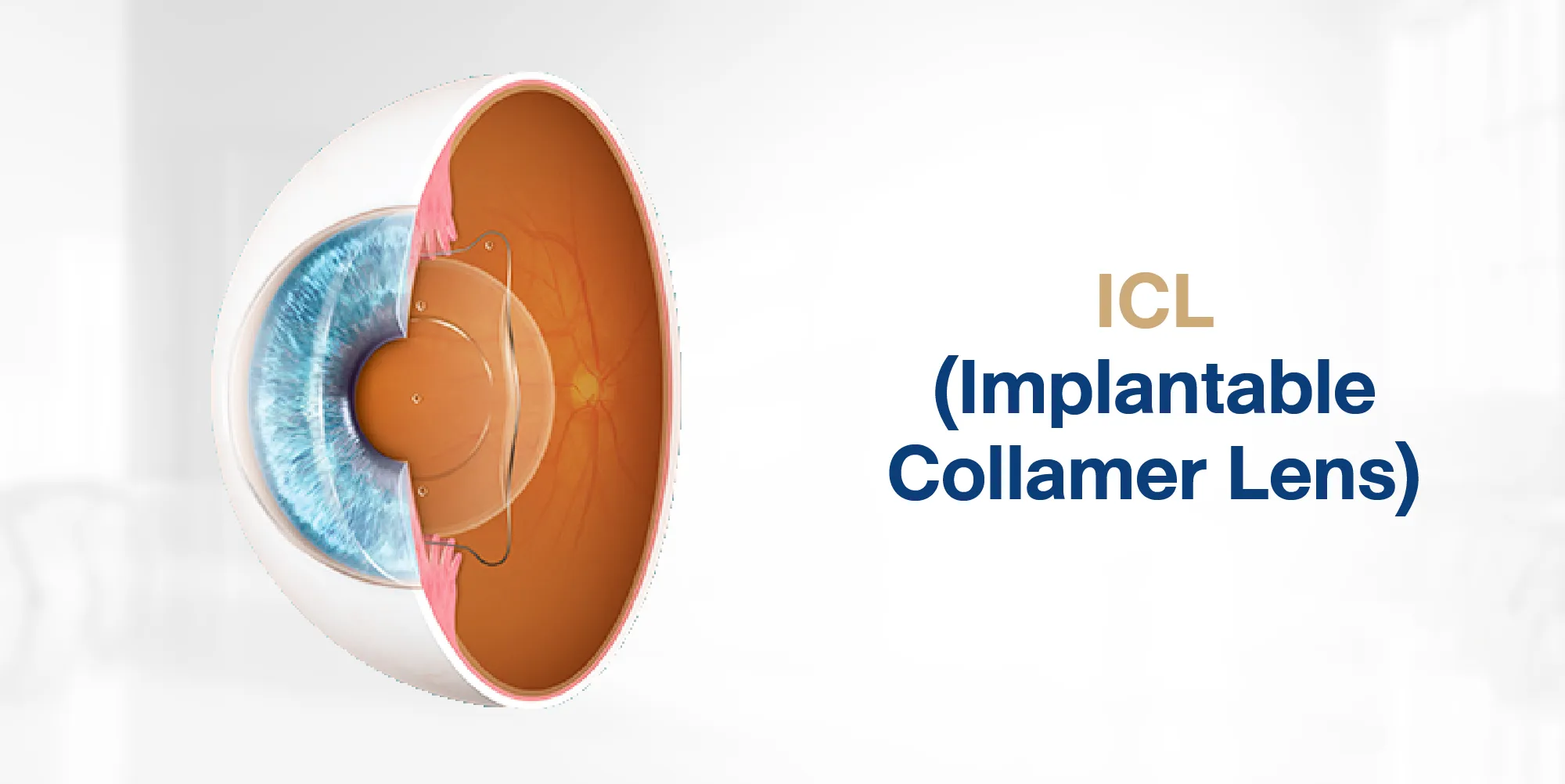 ICL (Implantable Collamer Lens)